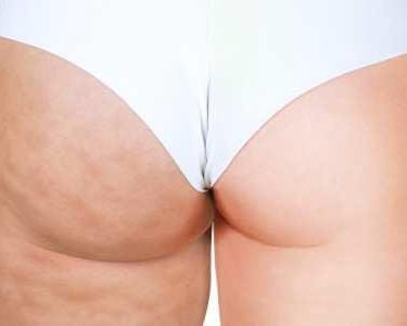 Cellulite_fesses_01 Cryo et cellulite