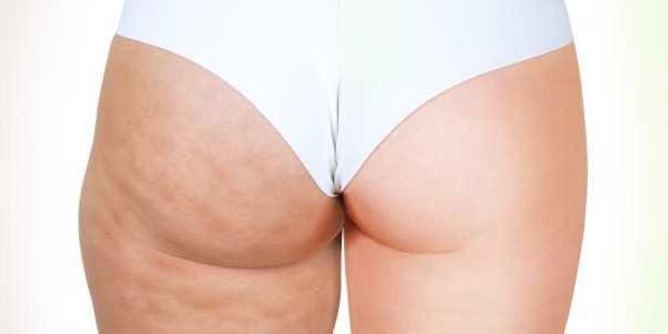 Cellulite_fesses_01 Cryo et cellulite